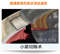 疏通原來(lái)的房水流出途徑