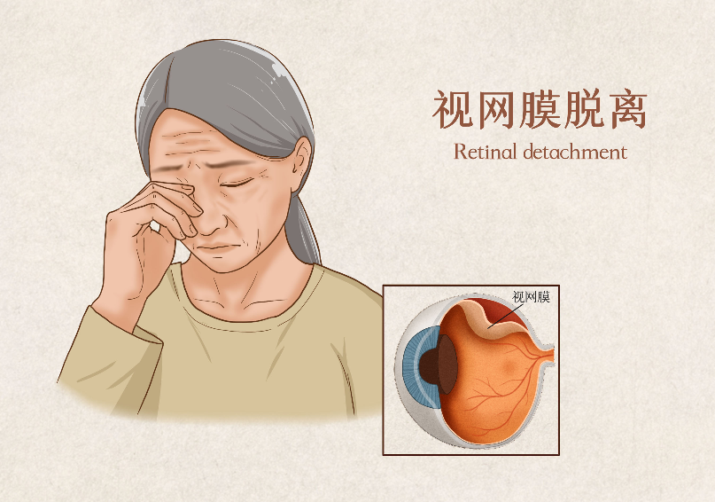 視網膜脫離手術多長時間