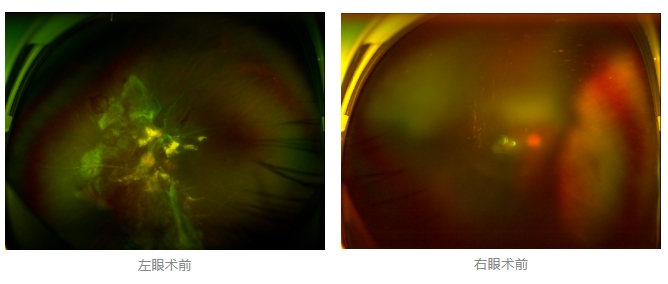 糖尿病視網(wǎng)膜病變